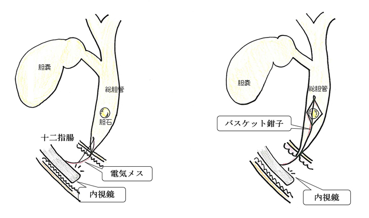 経口内視鏡による総胆管結石の摘出方法