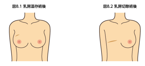 図8.1乳房温存術後　図8.2乳房切除術後