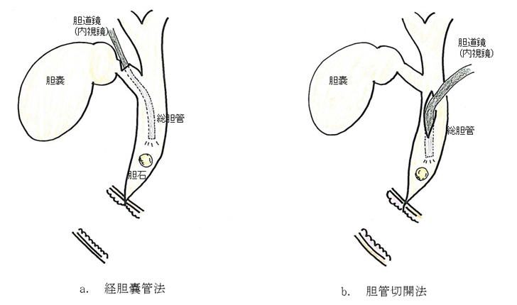 外科手術による総胆管結石の摘出方法